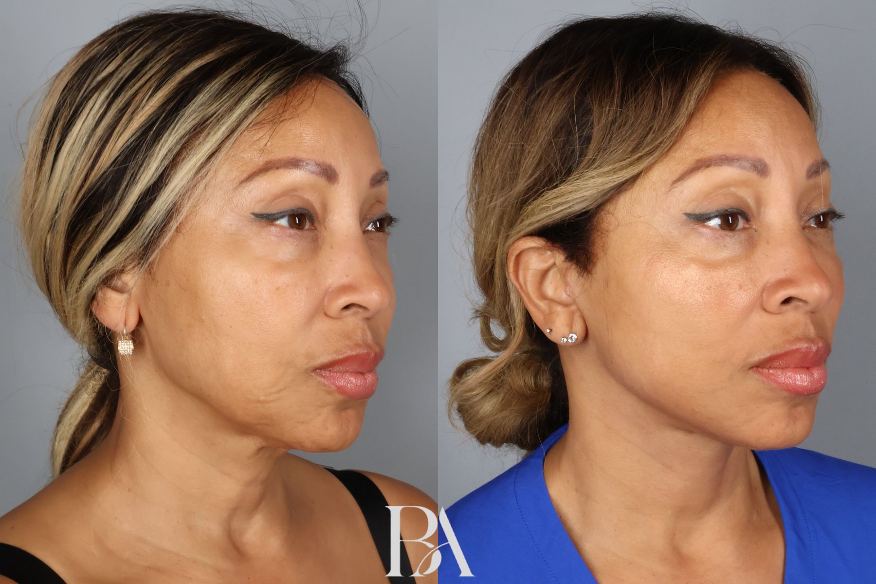 Face/Neck Lift before and after — oblique view, Dr. Beina Azadgoli, Beverly Hills