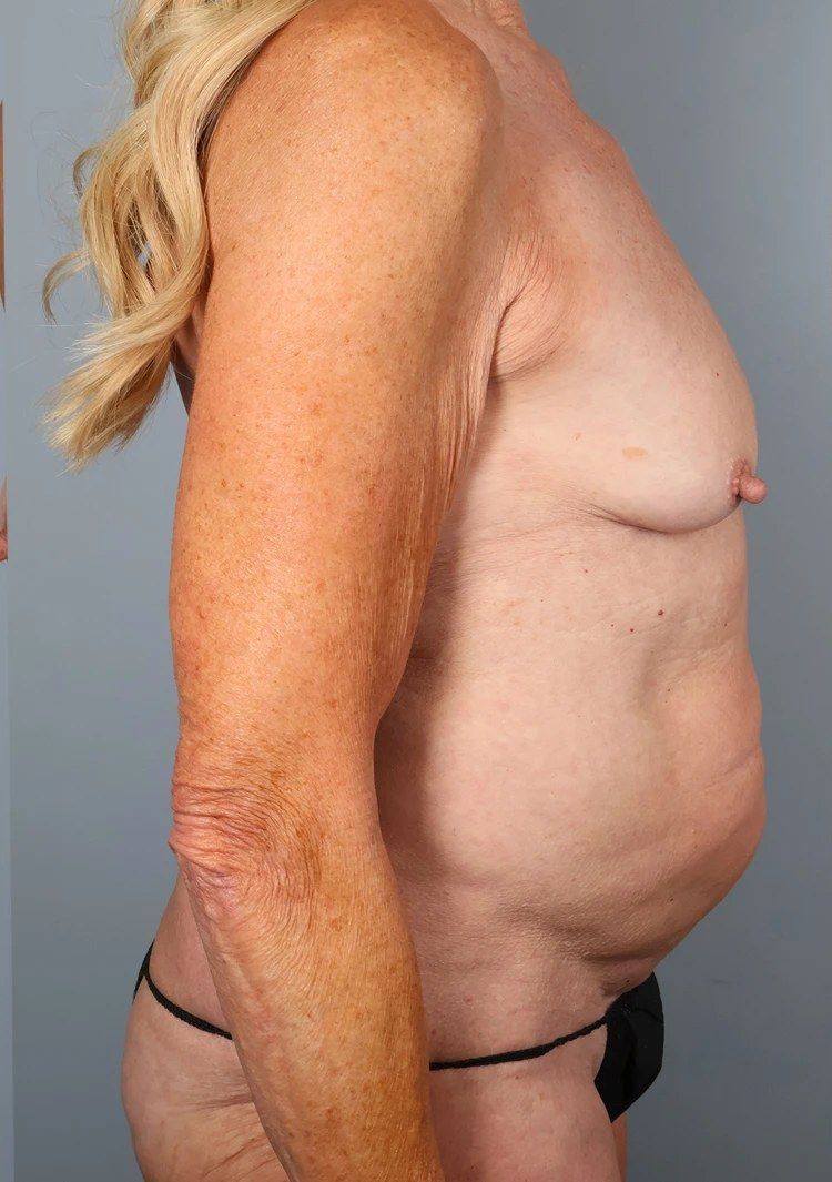 Before — Tummy Tuck (Abdominoplasty)