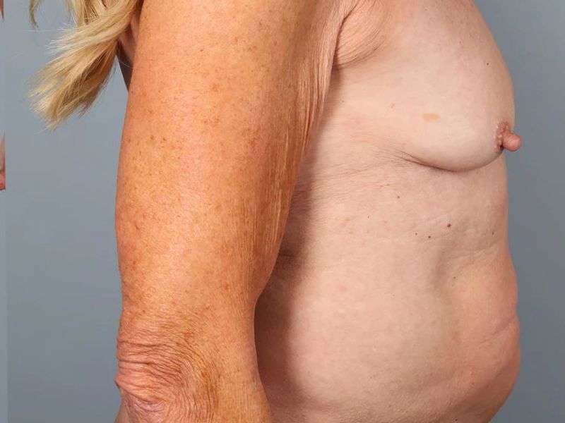 Before — Tummy Tuck (Abdominoplasty)