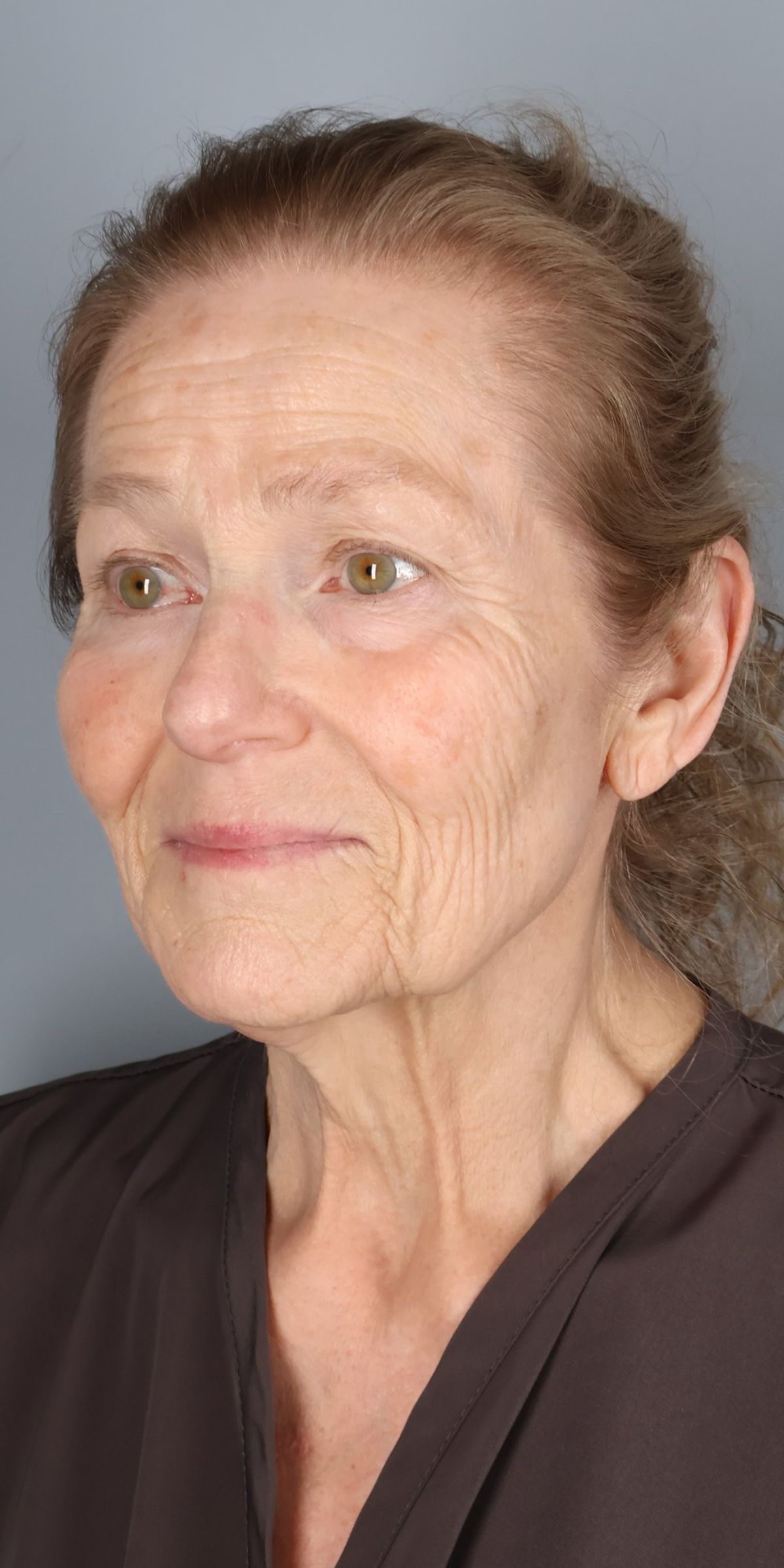 Face/neck lift before — three-quarter view, Dr. Beina Azadgoli, Beverly Hills