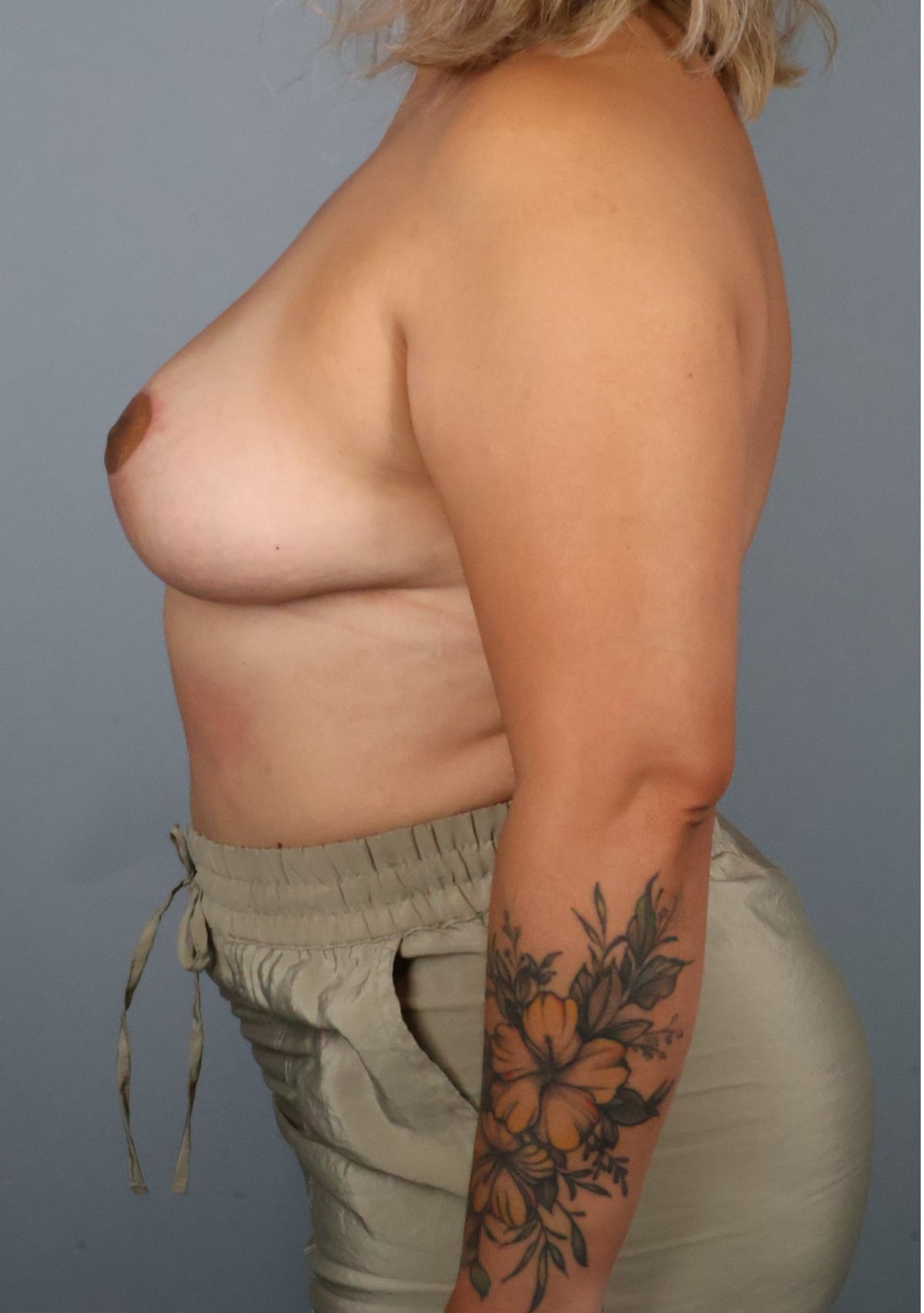 Breast implant removal after — side view, Dr. Beina Azadgoli, Beverly Hills