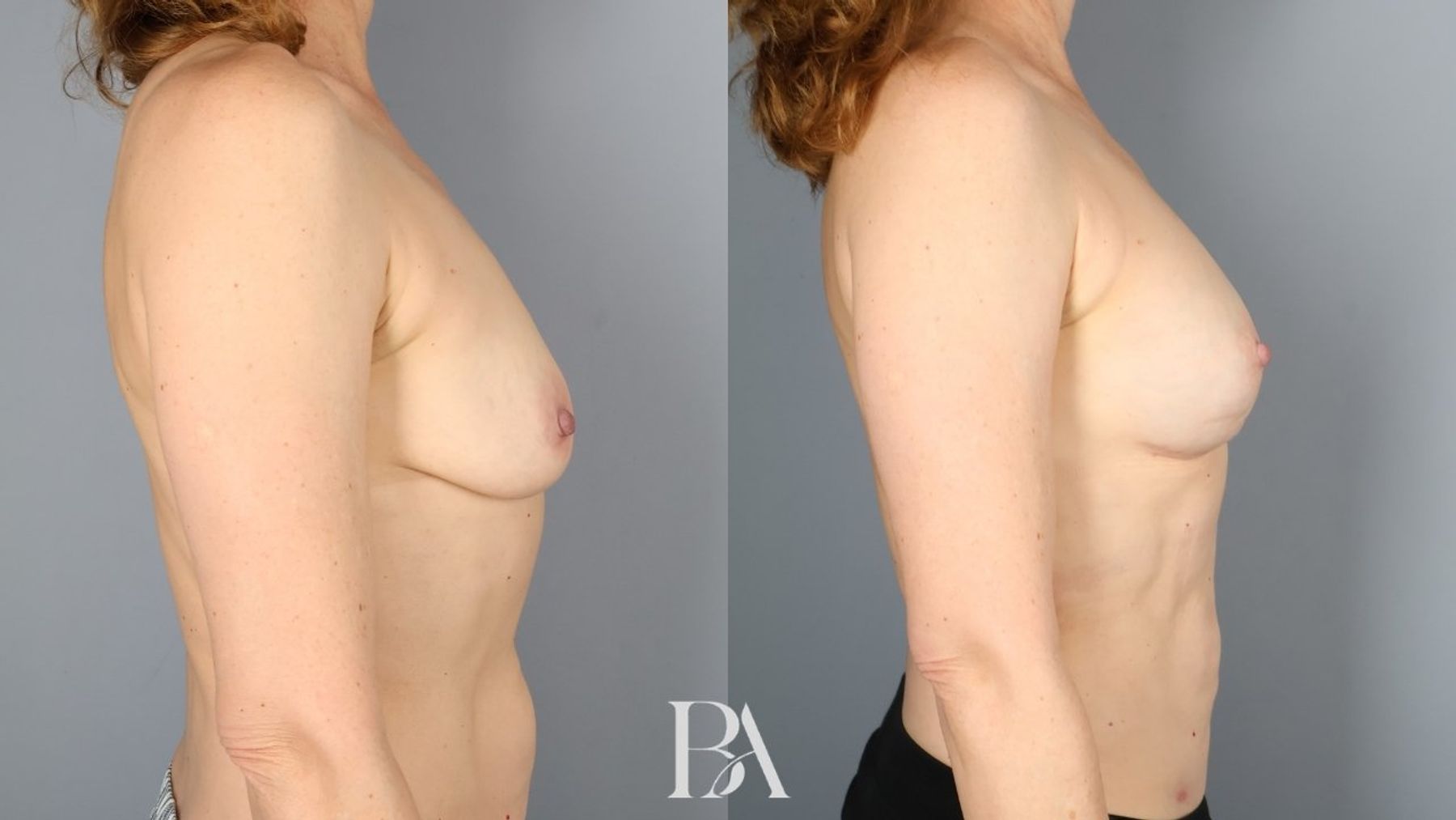 Direct-to-Implant Reconstruction before and after — side view, Dr. Beina Azadgoli, Beverly Hills
