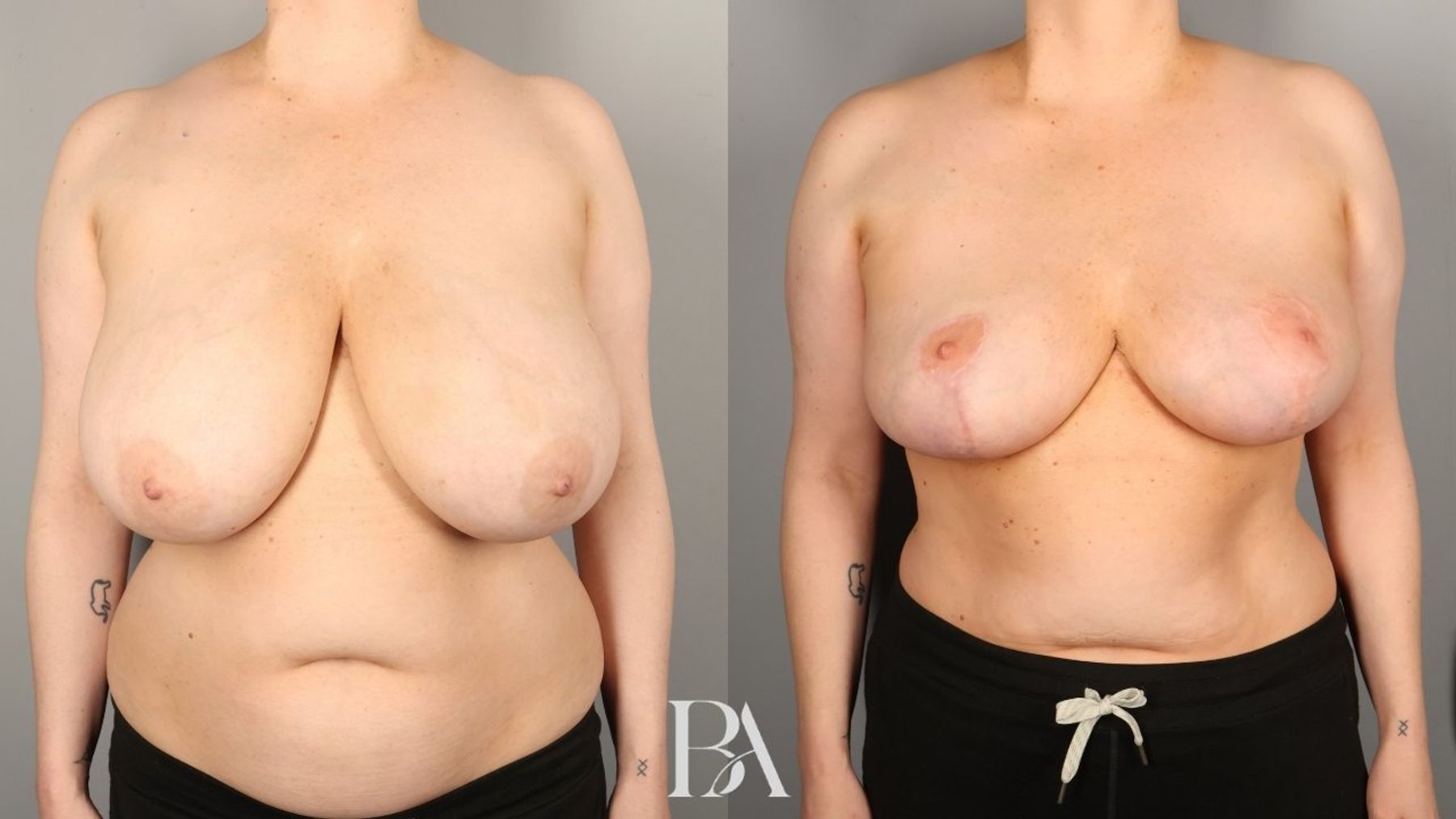 Oncoplastic Reduction before and after — front view, Dr. Beina Azadgoli, Beverly Hills