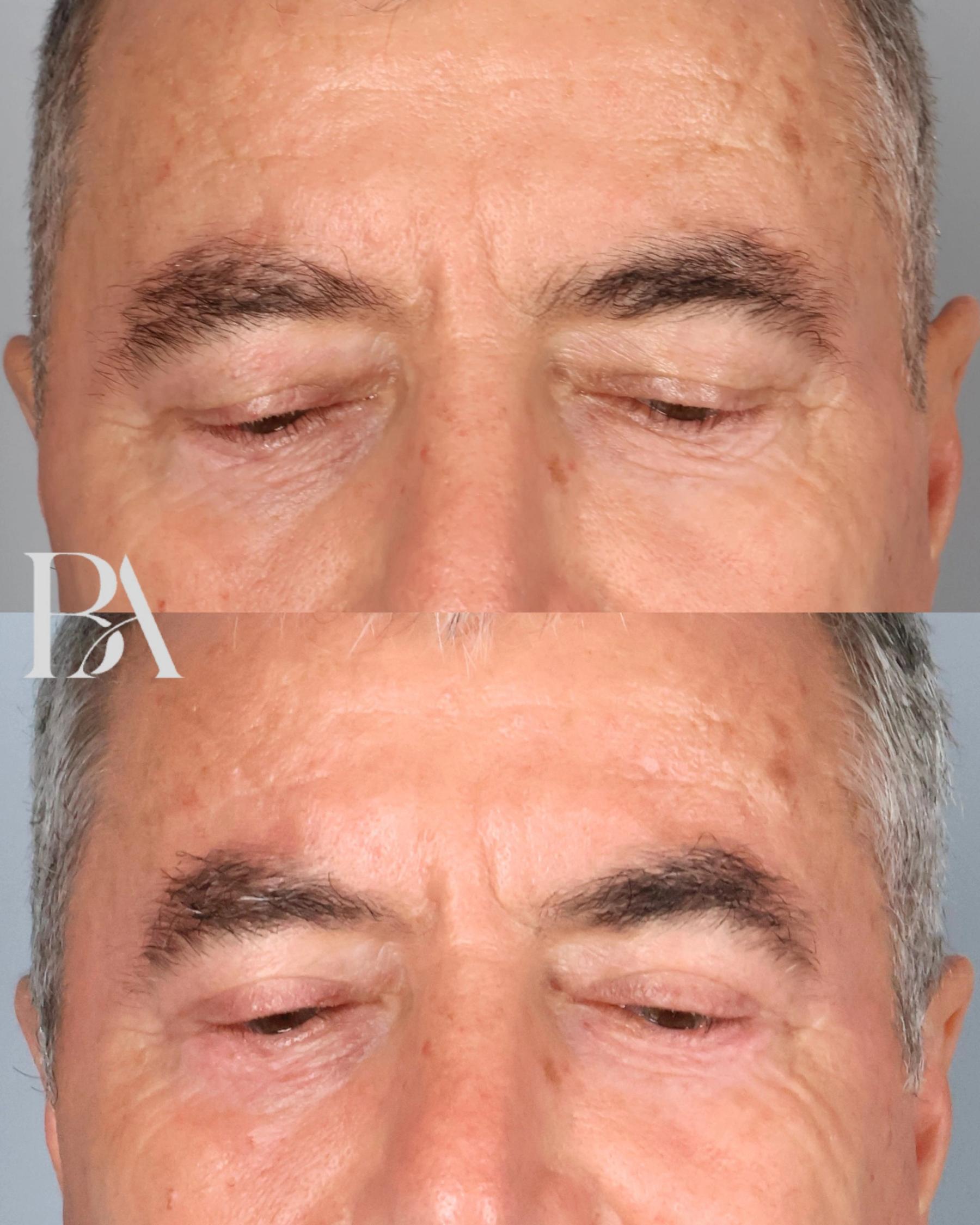Upper Blepharoplasty before and after — detail view, Dr. Beina Azadgoli, Beverly Hills