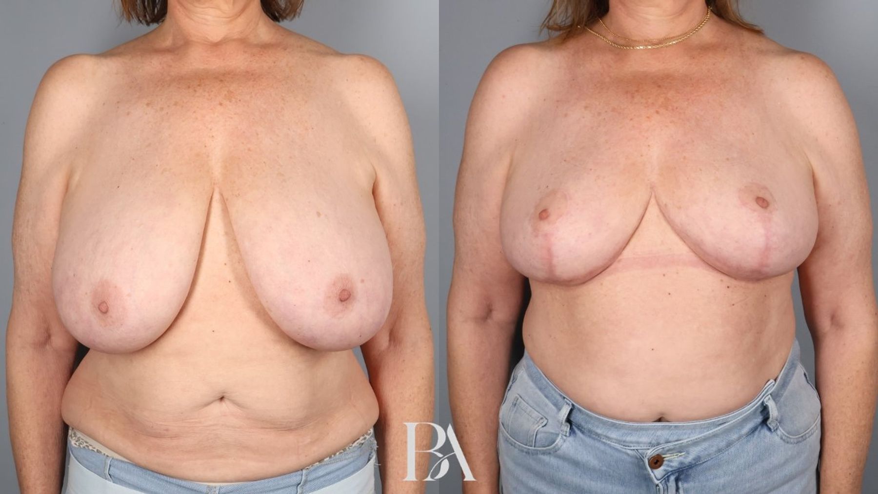 Breast reduction before and after — front view, Dr. Beina Azadgoli, Beverly Hills