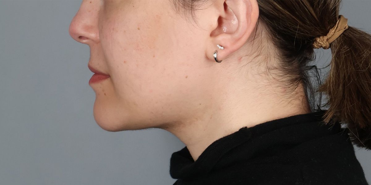 Submental liposuction after — detail view, Dr. Beina Azadgoli, Beverly Hills