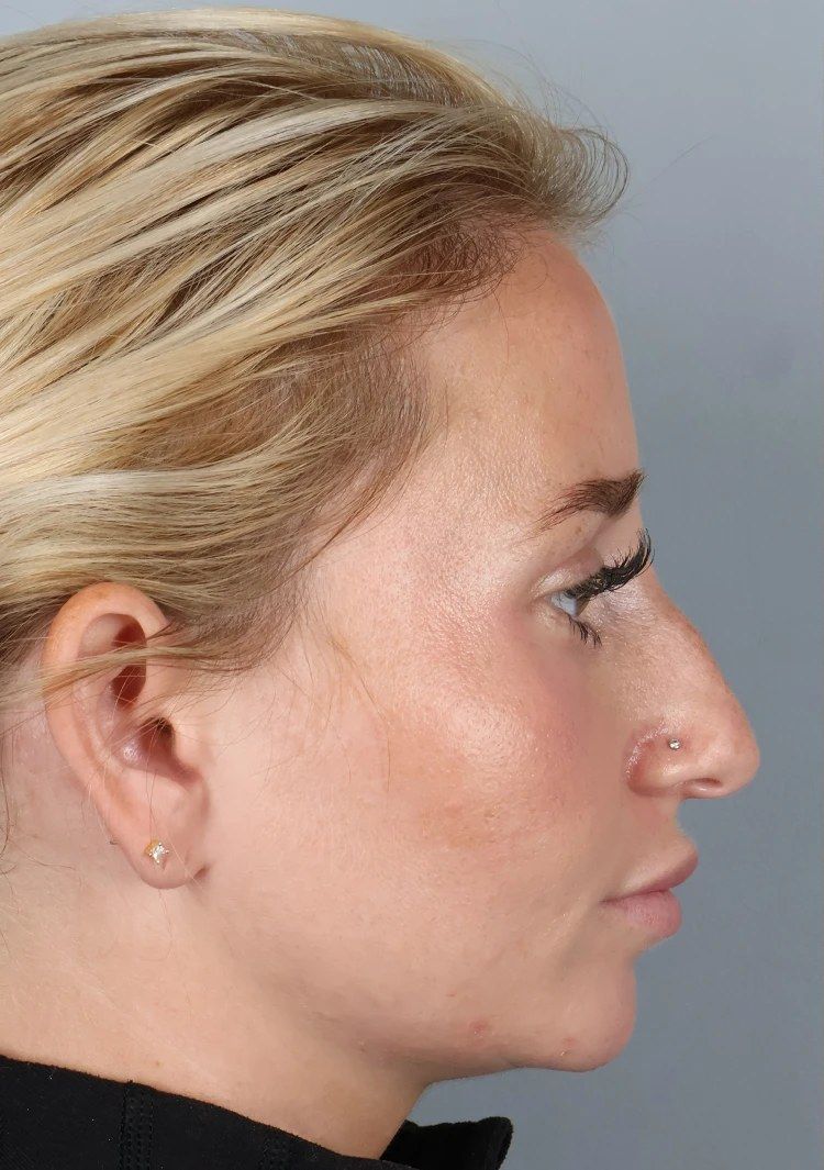 Before — Rhinoplasty