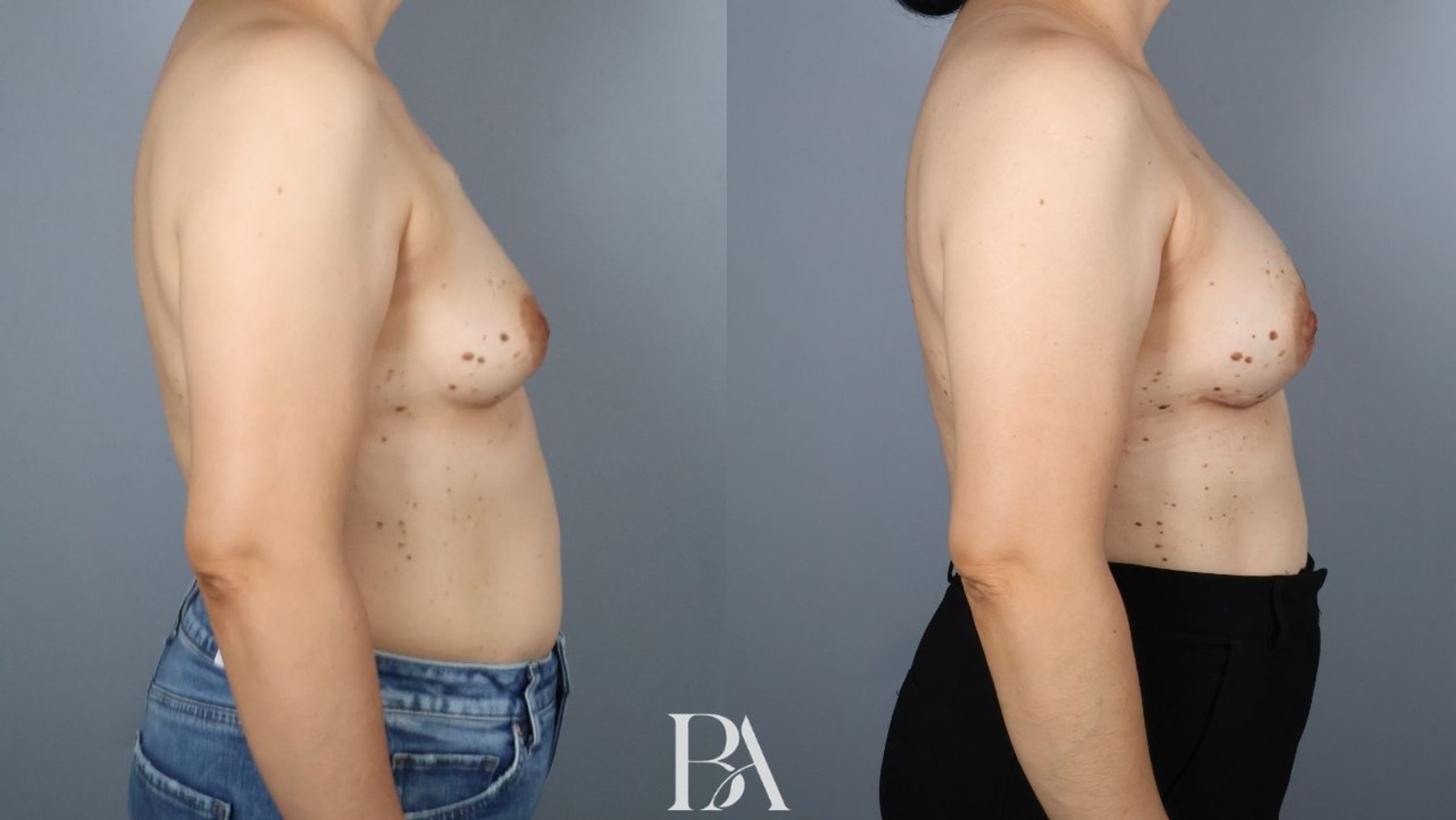 Direct-to-Implant Reconstruction before and after — oblique view, Dr. Beina Azadgoli, Beverly Hills