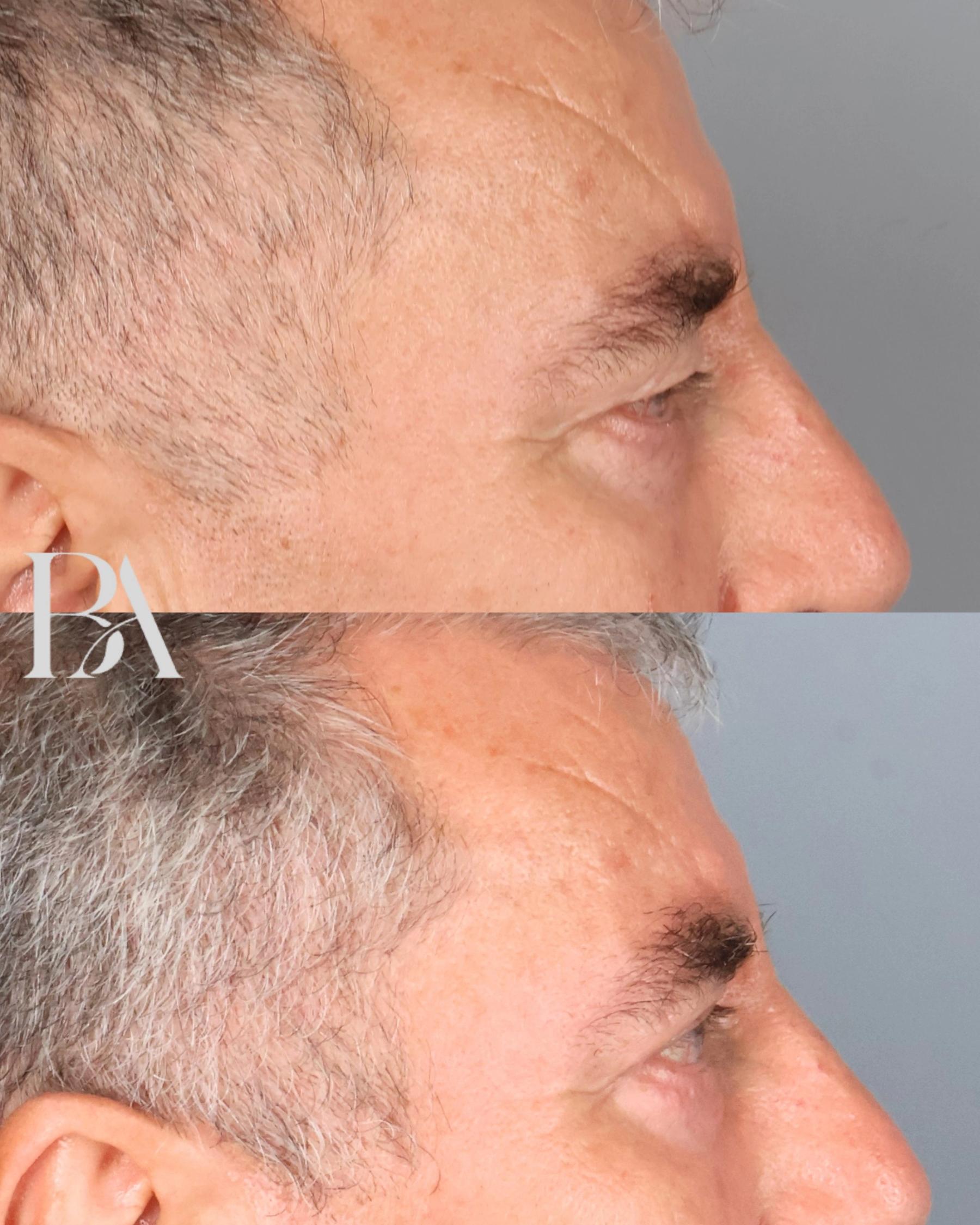 Upper Blepharoplasty before and after — side view, Dr. Beina Azadgoli, Beverly Hills