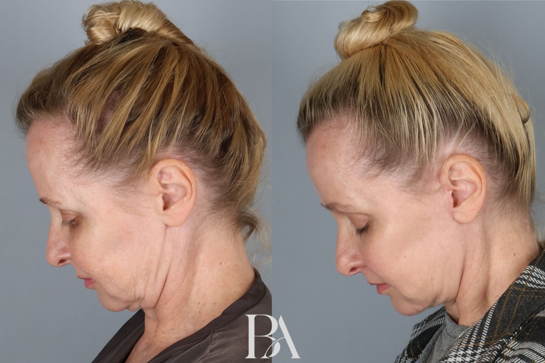 Face/Neck Lift before and after — detail view, Dr. Beina Azadgoli, Beverly Hills