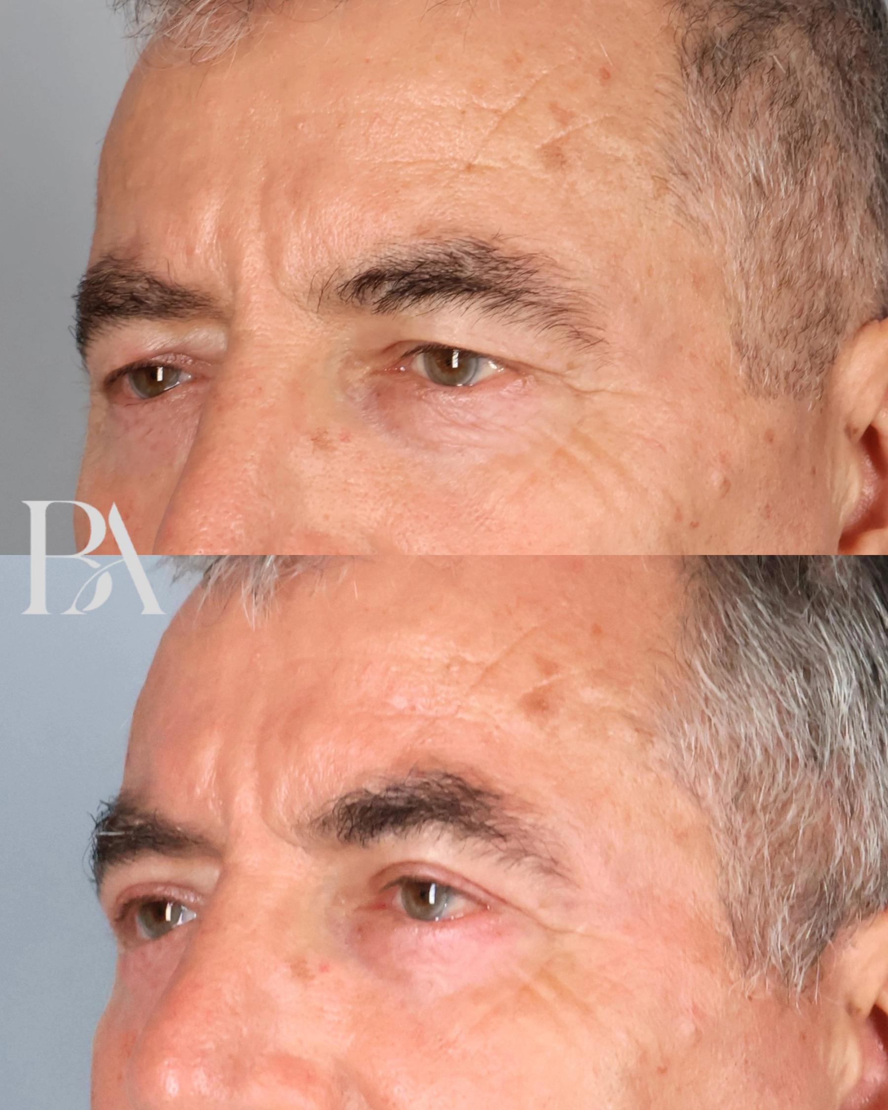 Upper Blepharoplasty before and after — three-quarter view, Dr. Beina Azadgoli, Beverly Hills