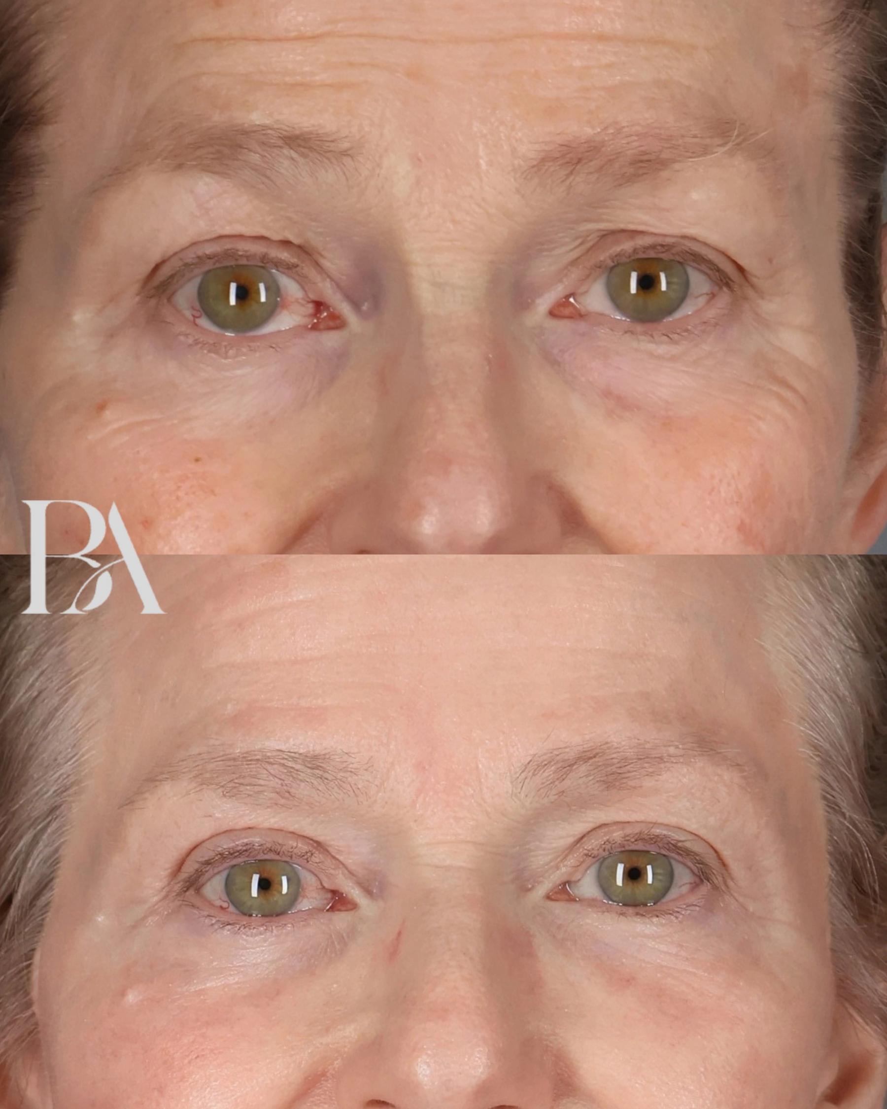 Upper Blepharoplasty before and after — front view, Dr. Beina Azadgoli, Beverly Hills