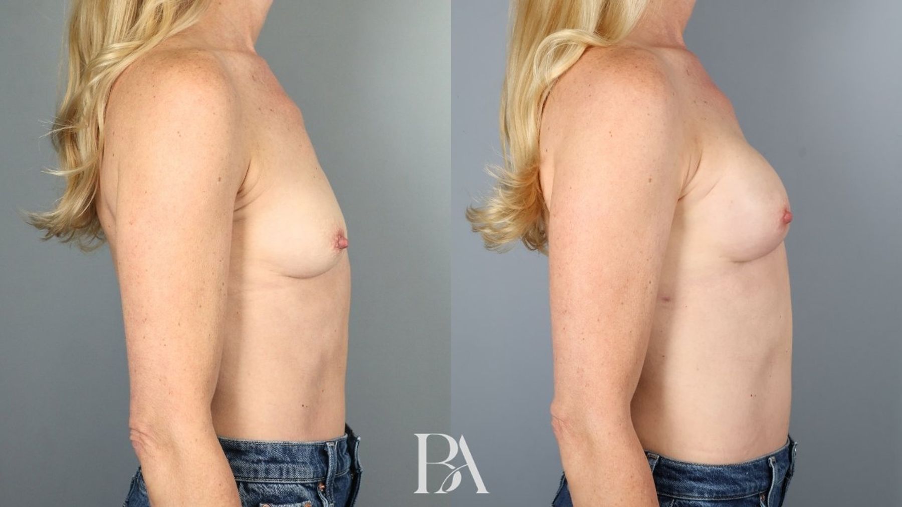 Direct-to-Implant Reconstruction before and after — side view, Dr. Beina Azadgoli, Beverly Hills