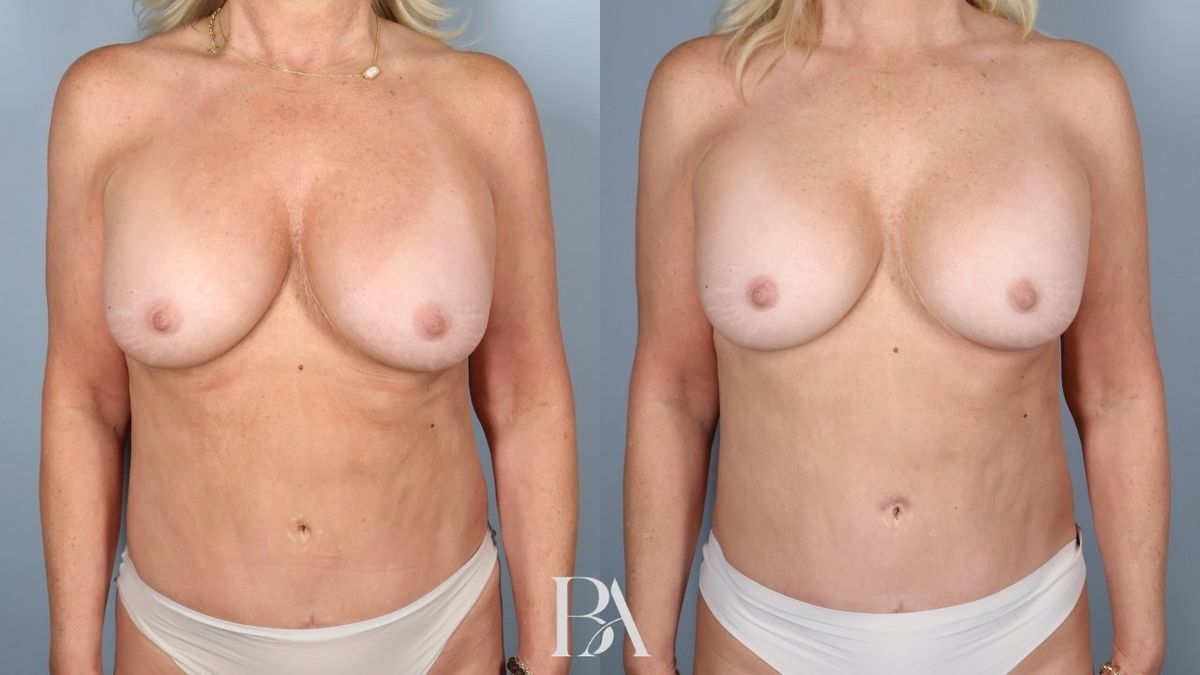 Before and after — Implant Removal and Replacement