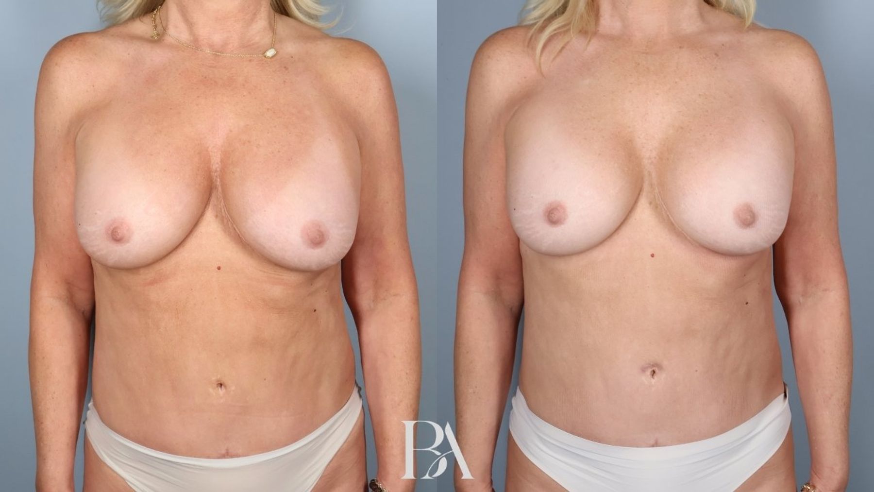 Implant Removal and Replacement before and after — front view, Dr. Beina Azadgoli, Beverly Hills