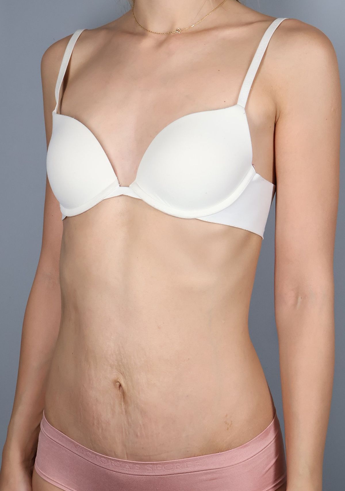 Rectus diastasis repair after — three-quarter view, Dr. Beina Azadgoli, Beverly Hills