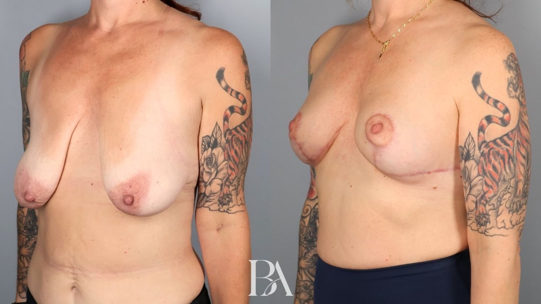 Breast lift before and after — three-quarter view, Dr. Beina Azadgoli, Beverly Hills