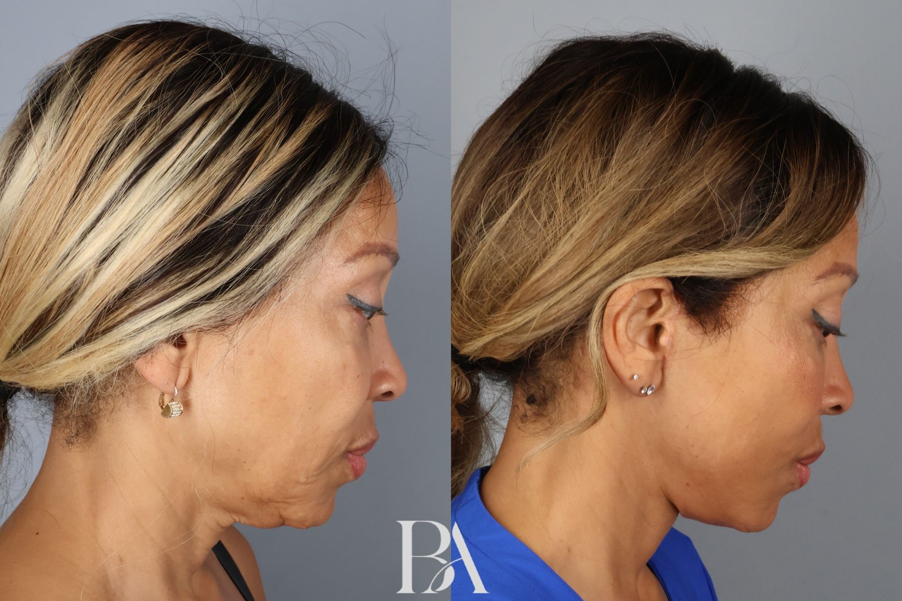 Face/Neck Lift before and after — side view, Dr. Beina Azadgoli, Beverly Hills