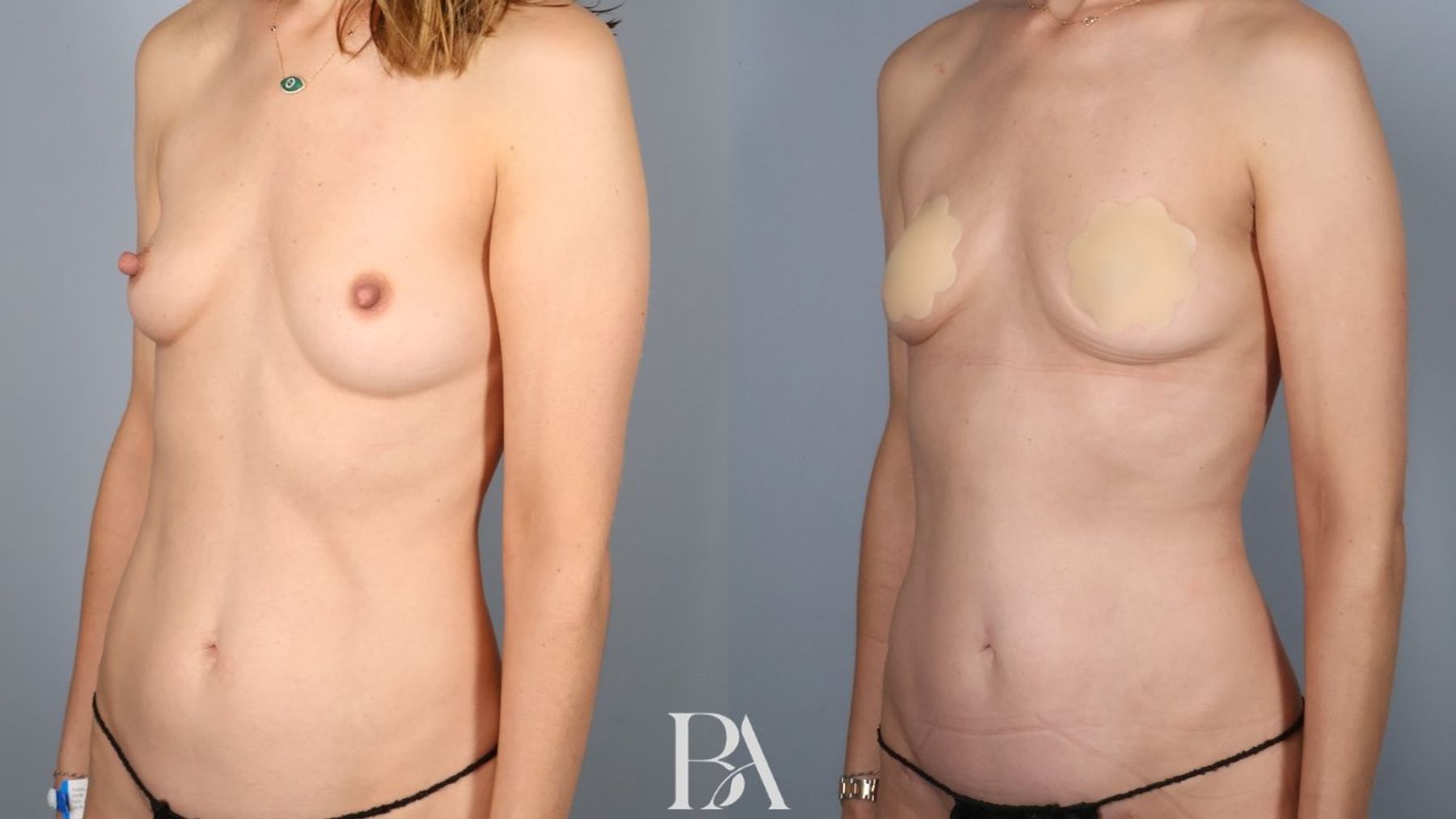 Tummy tuck before and after — side view, Dr. Beina Azadgoli, Beverly Hills