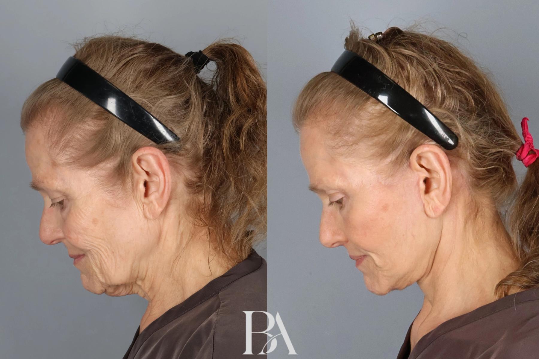 Face/Neck Lift before and after — detail view, Dr. Beina Azadgoli, Beverly Hills