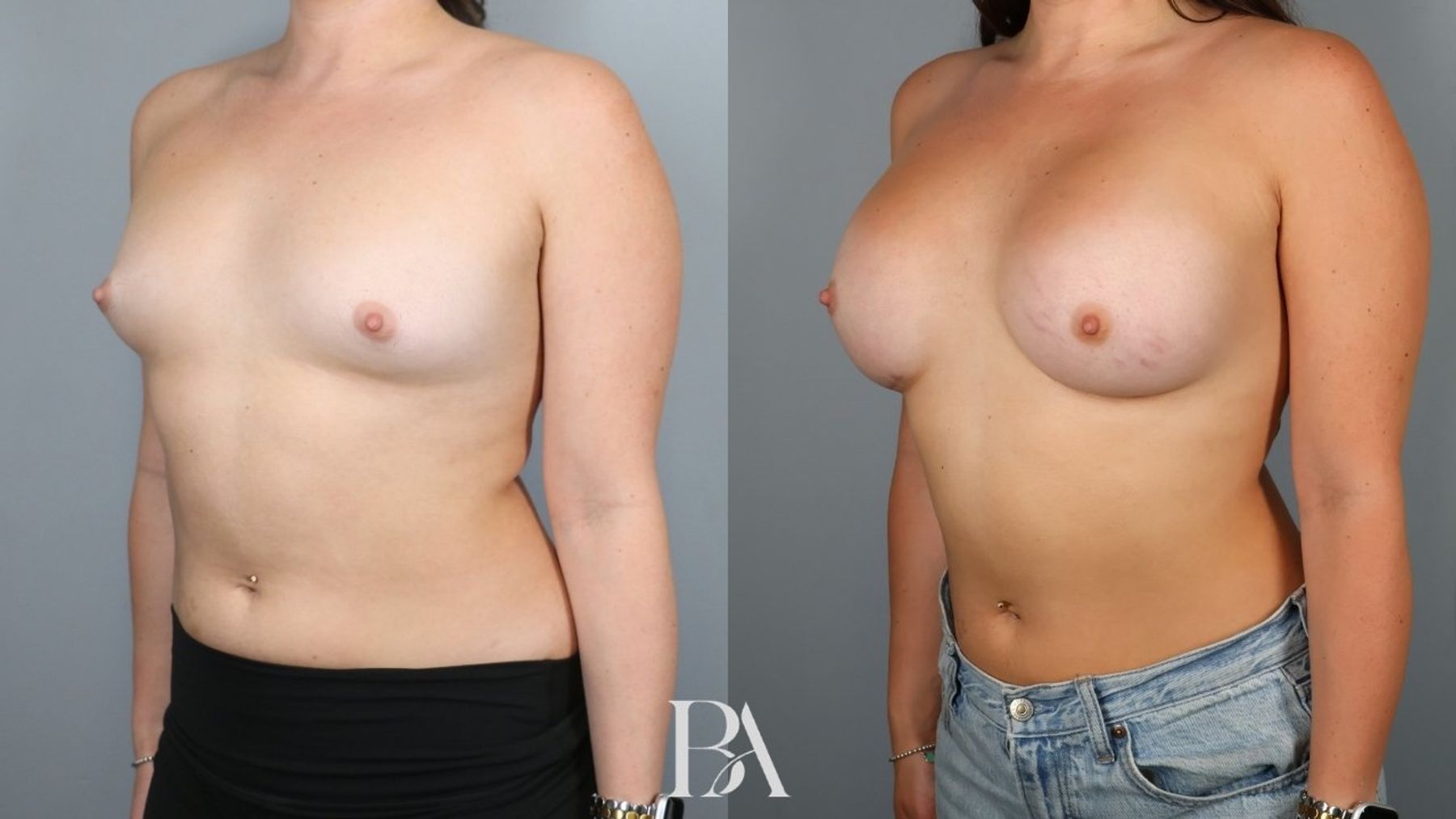 Breast augmentation before and after — three-quarter view, Dr. Beina Azadgoli, Beverly Hills