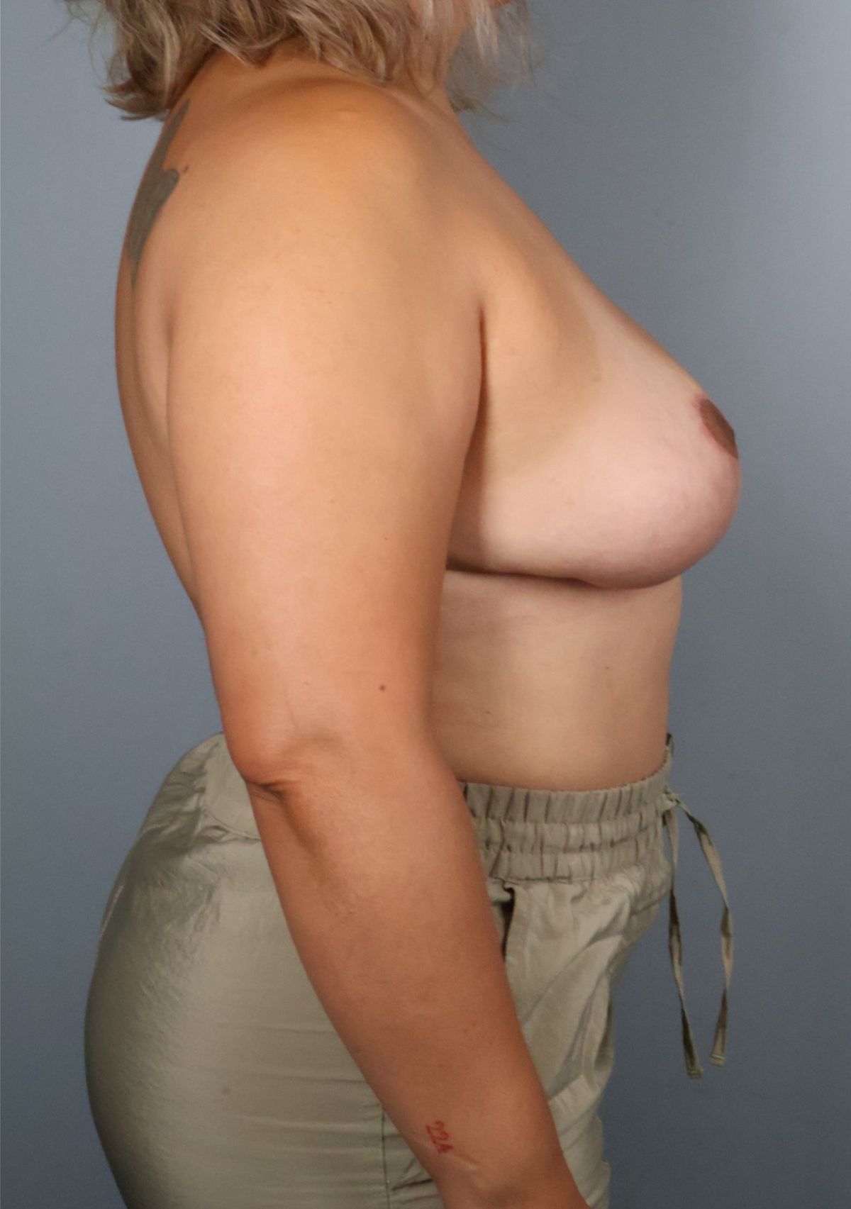 Breast implant removal after — detail view, Dr. Beina Azadgoli, Beverly Hills