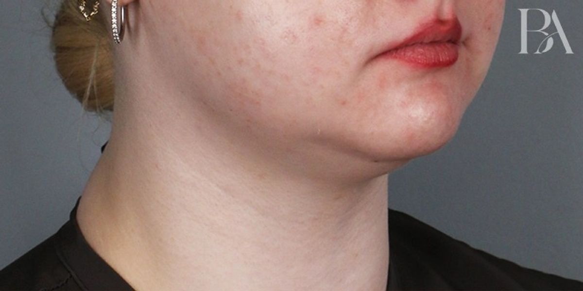 Case 4001 — Oblique before