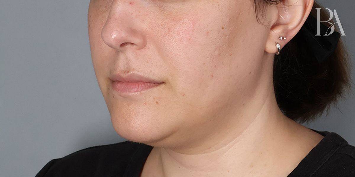 Submental liposuction before — side view, Dr. Beina Azadgoli, Beverly Hills