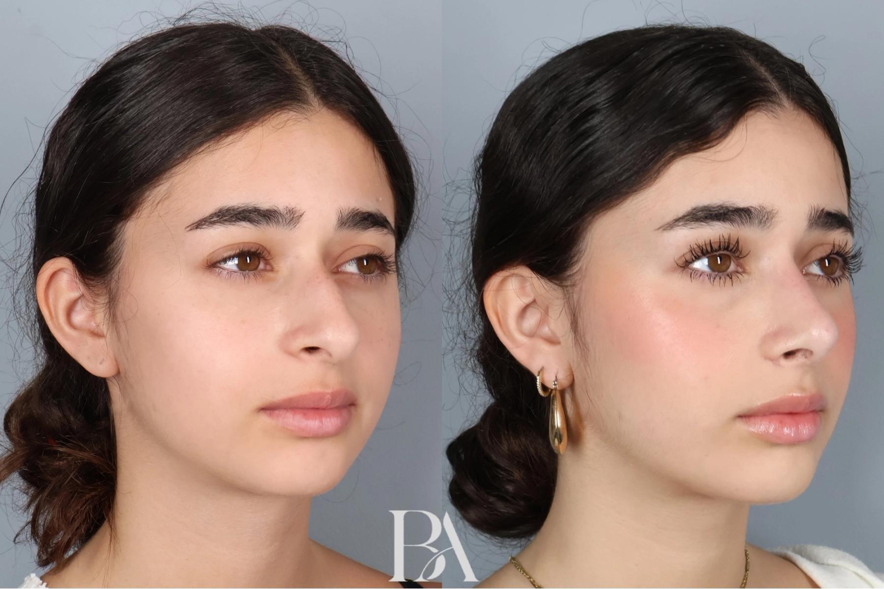 Rhinoplasty before and after — oblique view, Dr. Beina Azadgoli, Beverly Hills