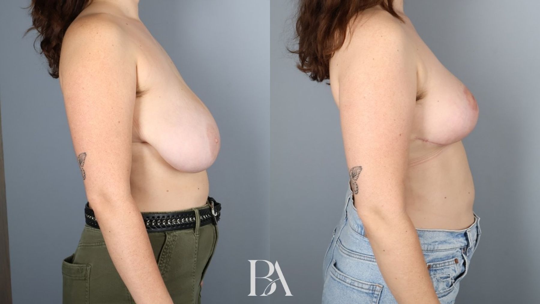 Breast reduction before and after — side view, Dr. Beina Azadgoli, Beverly Hills
