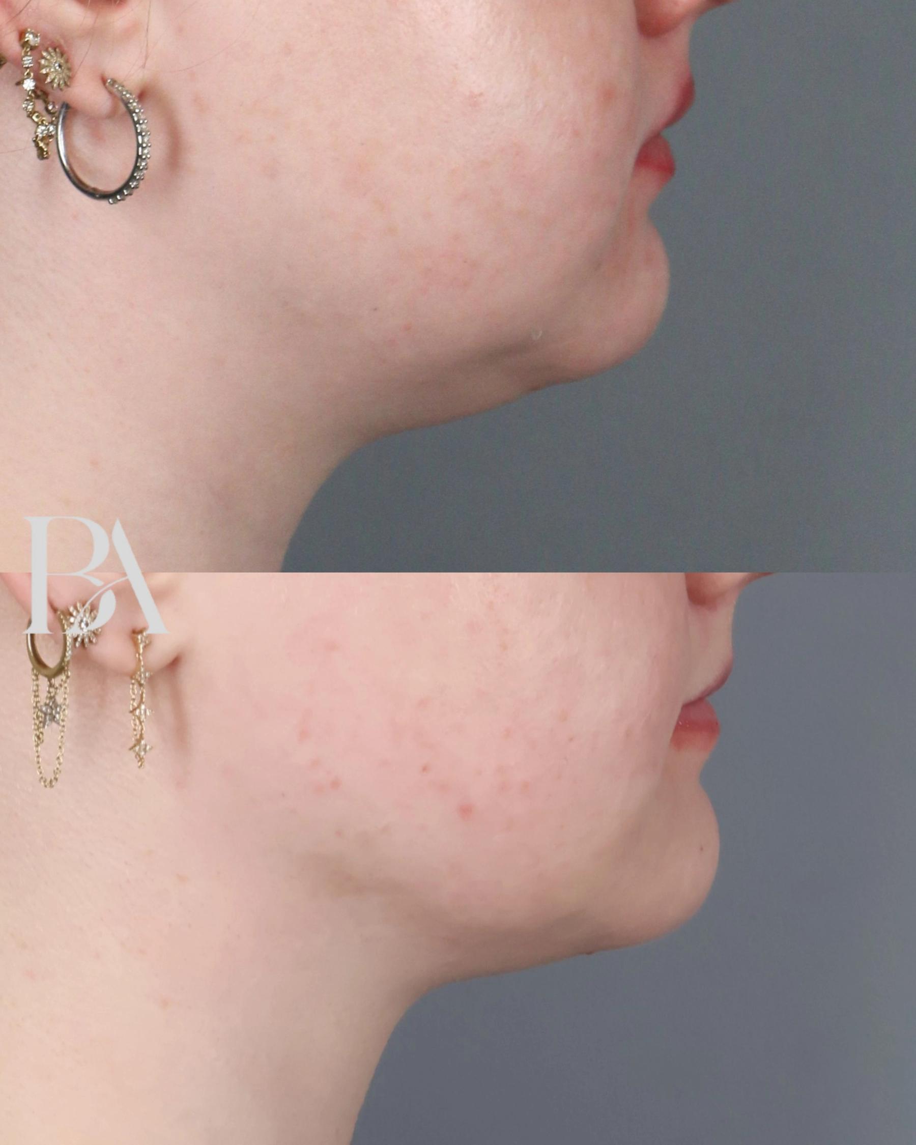 Submental Liposuction before and after — side view, Dr. Beina Azadgoli, Beverly Hills