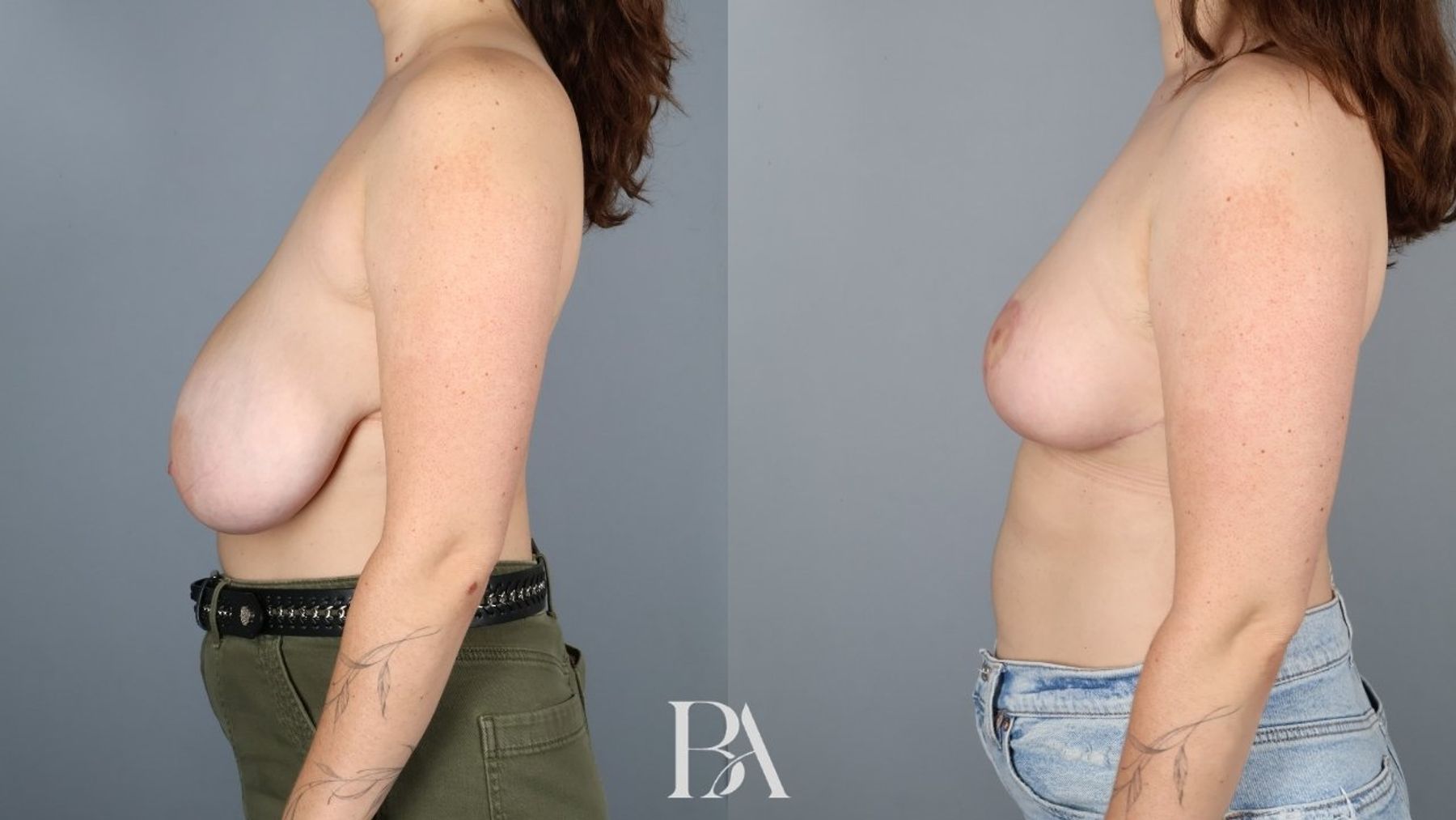 Breast reduction before and after — side view, Dr. Beina Azadgoli, Beverly Hills