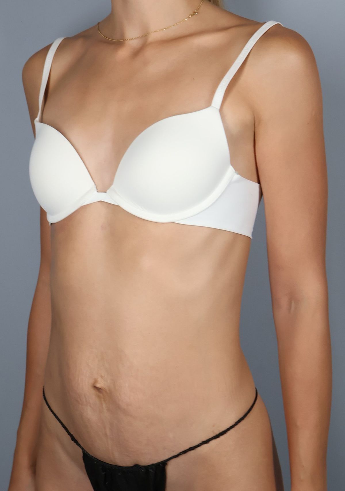 Rectus diastasis repair before — three-quarter view, Dr. Beina Azadgoli, Beverly Hills
