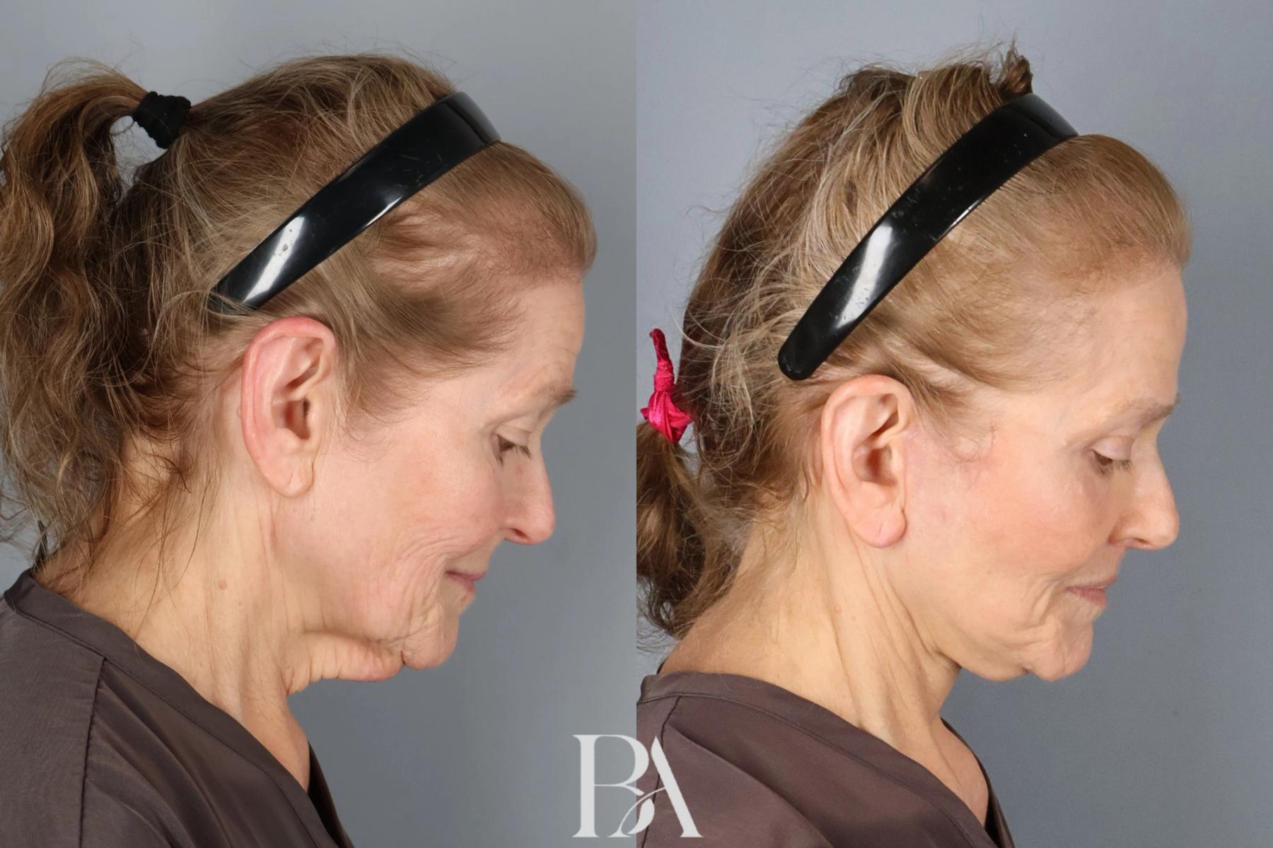 Face/Neck Lift before and after — detail view, Dr. Beina Azadgoli, Beverly Hills