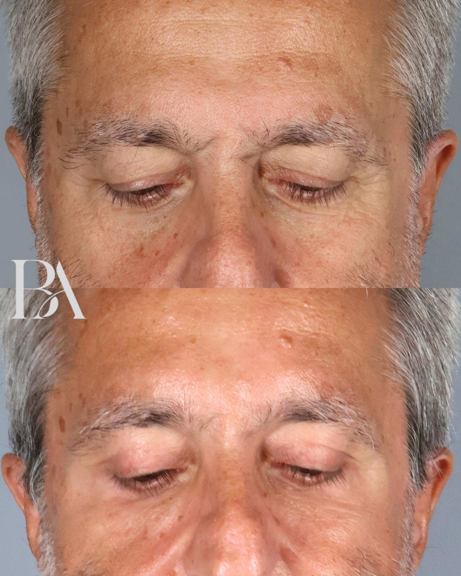 Upper Blepharoplasty before and after — detail view, Dr. Beina Azadgoli, Beverly Hills