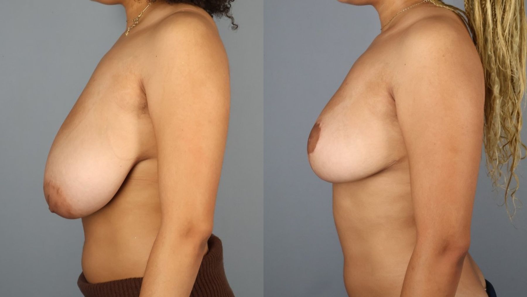 Breast reduction before and after — side view, Dr. Beina Azadgoli, Beverly Hills