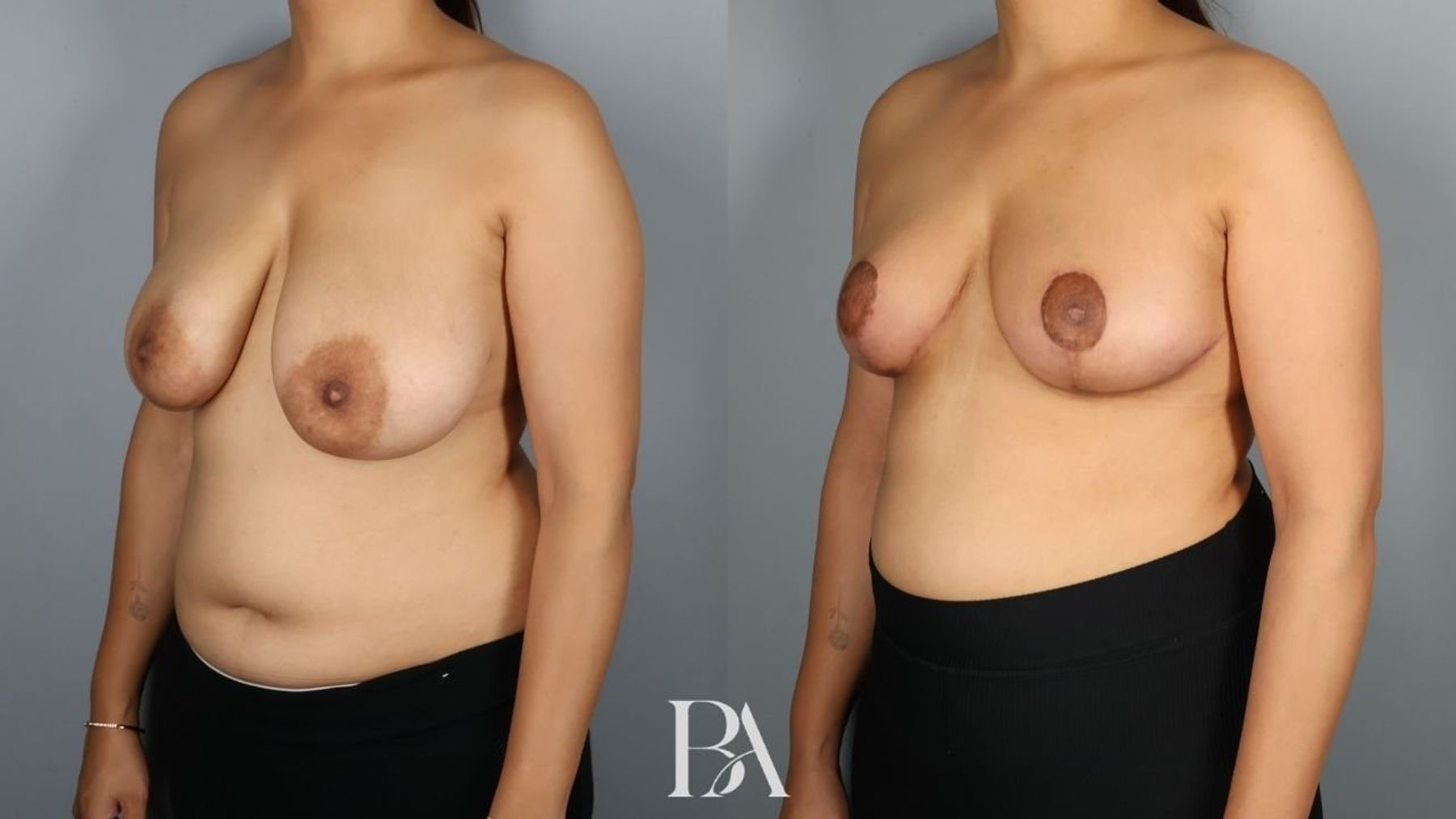 Breast reduction before and after — three-quarter view, Dr. Beina Azadgoli, Beverly Hills