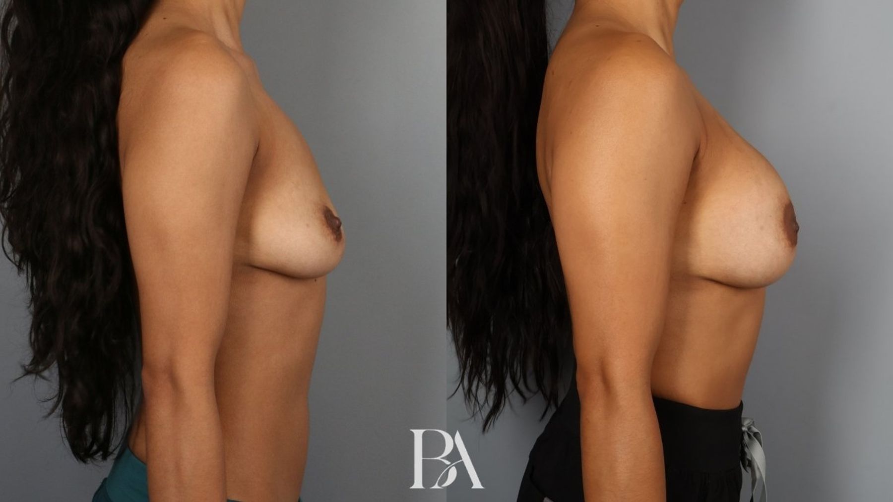 Breast augmentation before and after — side view, Dr. Beina Azadgoli, Beverly Hills