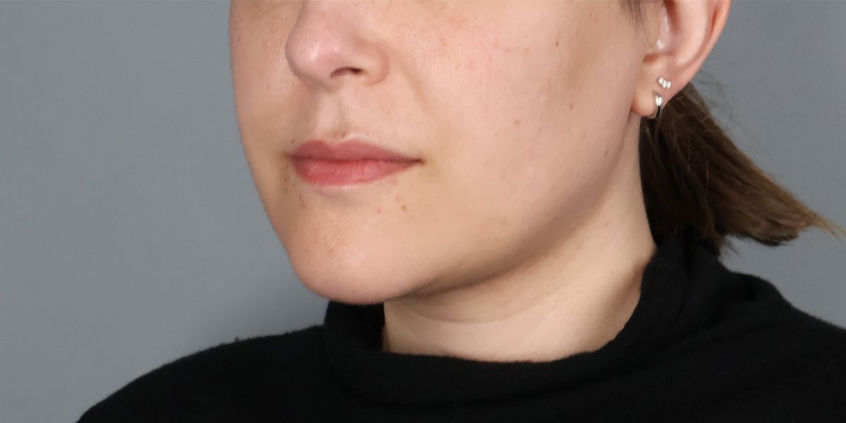 Submental liposuction after — side view, Dr. Beina Azadgoli, Beverly Hills