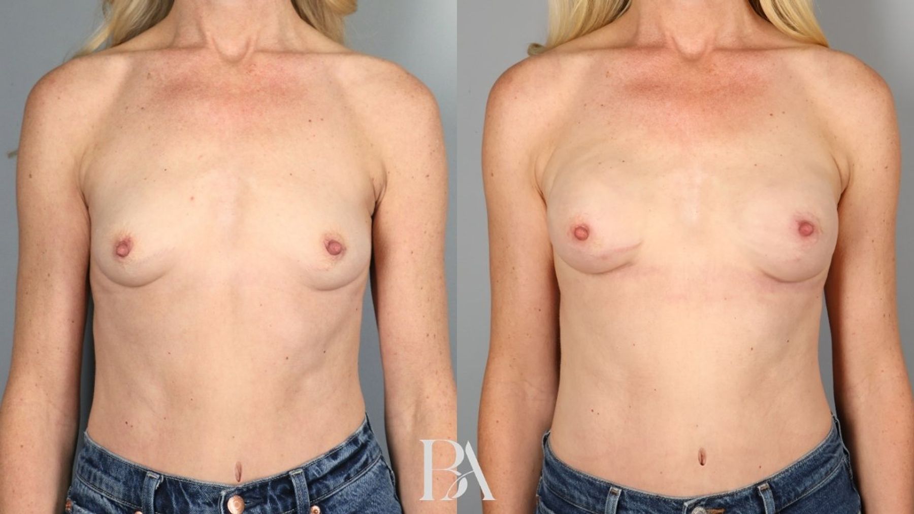 Direct-to-Implant Reconstruction before and after — front view, Dr. Beina Azadgoli, Beverly Hills
