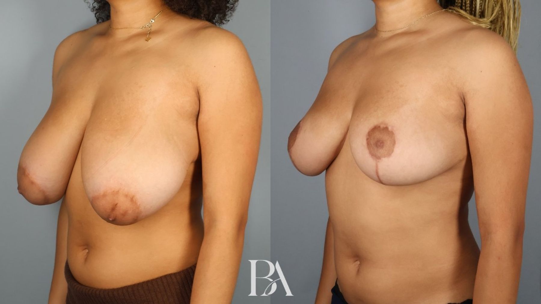 Breast reduction before and after — three-quarter view, Dr. Beina Azadgoli, Beverly Hills