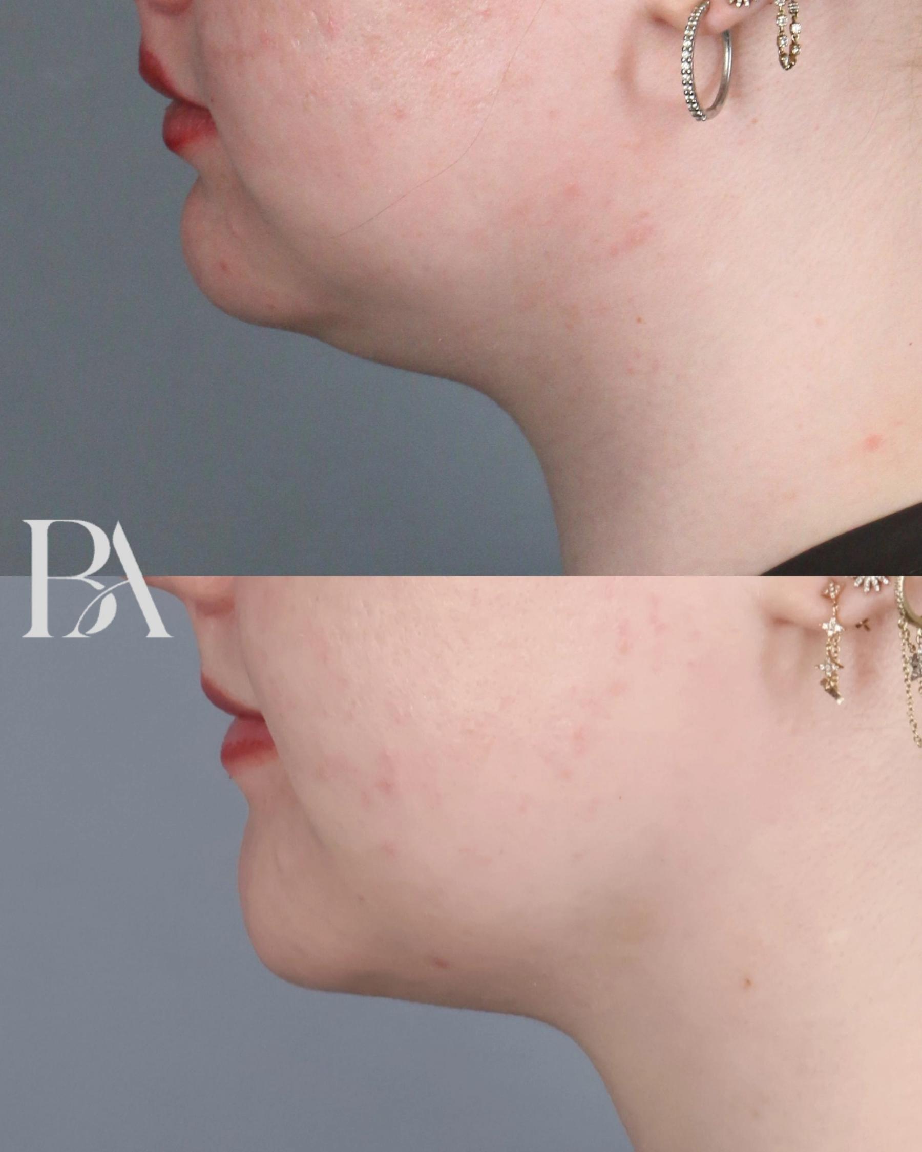 Submental Liposuction before and after — side view, Dr. Beina Azadgoli, Beverly Hills