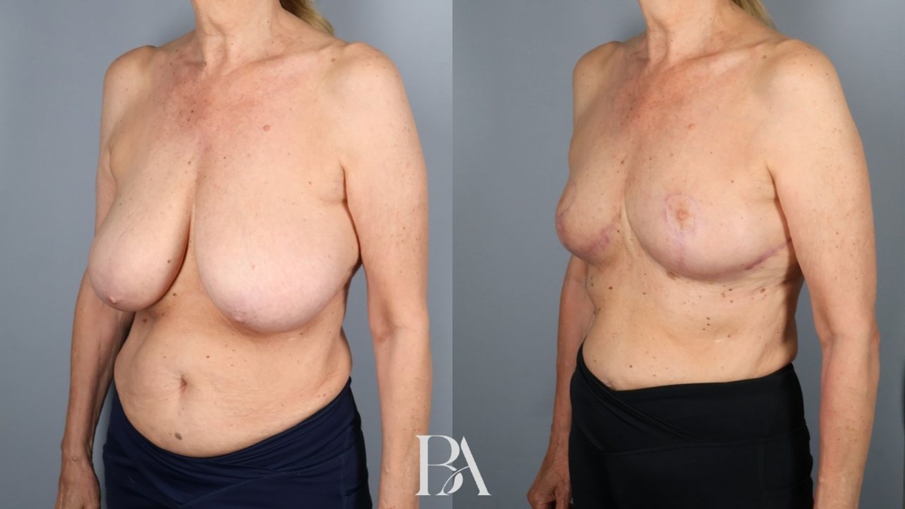 Breast reduction before and after — three-quarter view, Dr. Beina Azadgoli, Beverly Hills