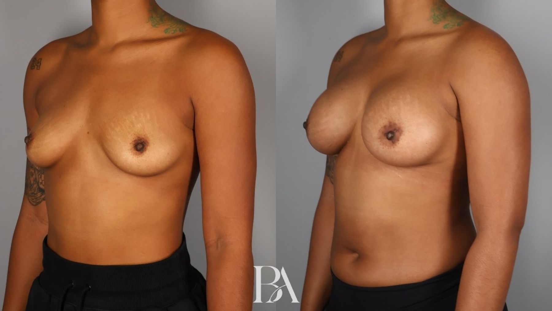 Breast augmentation before and after — three-quarter view, Dr. Beina Azadgoli, Beverly Hills