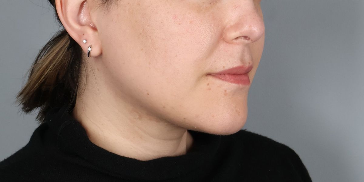 Submental liposuction after — oblique view, Dr. Beina Azadgoli, Beverly Hills