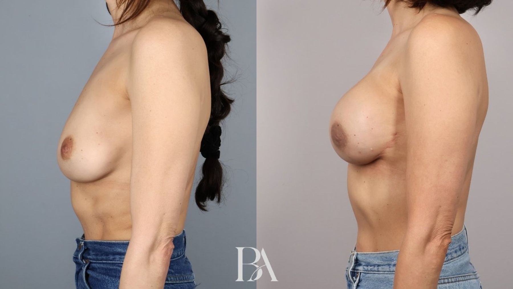 Direct-to-Implant Reconstruction before and after — side view, Dr. Beina Azadgoli, Beverly Hills
