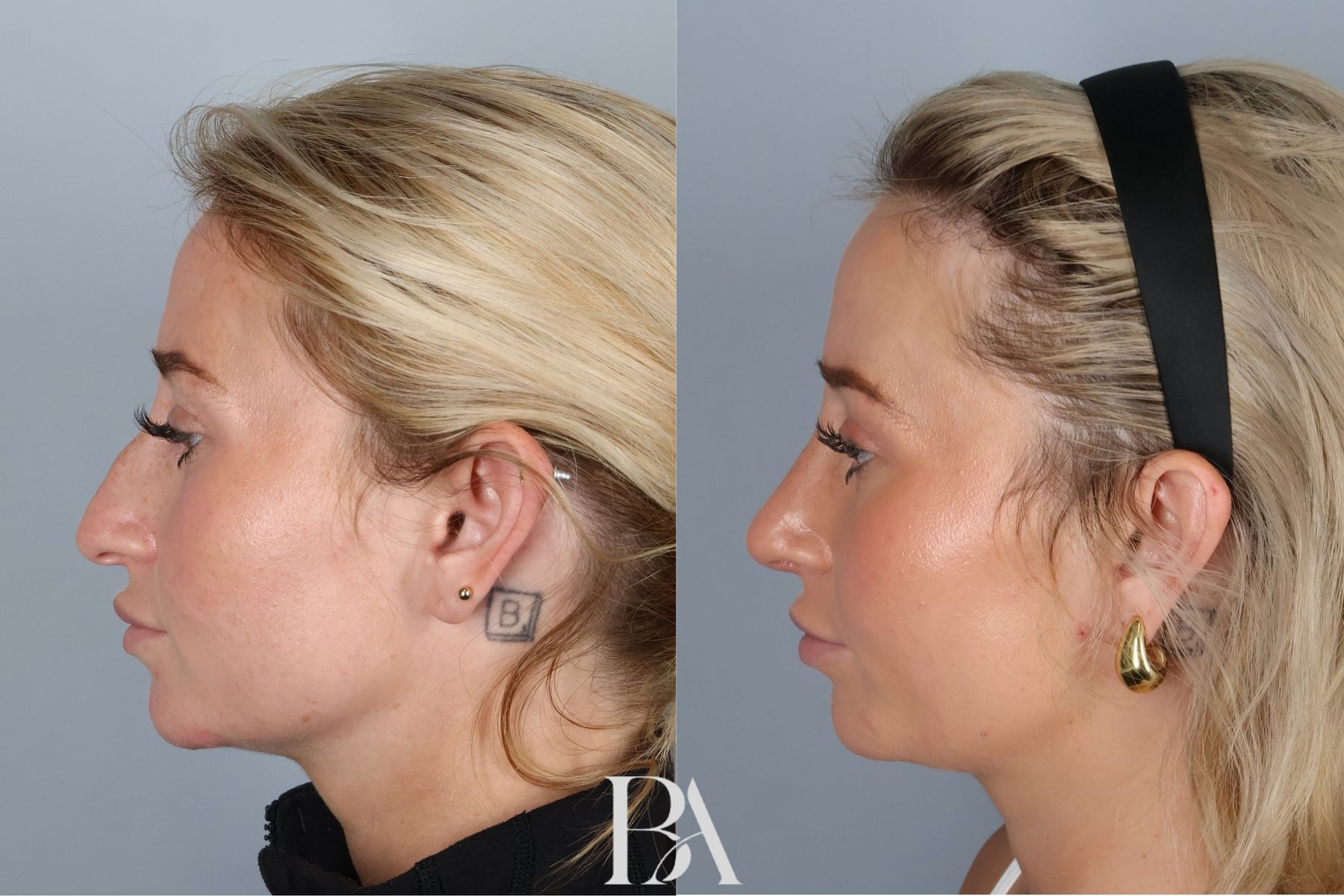 Rhinoplasty before and after — three-quarter view, Dr. Beina Azadgoli, Beverly Hills