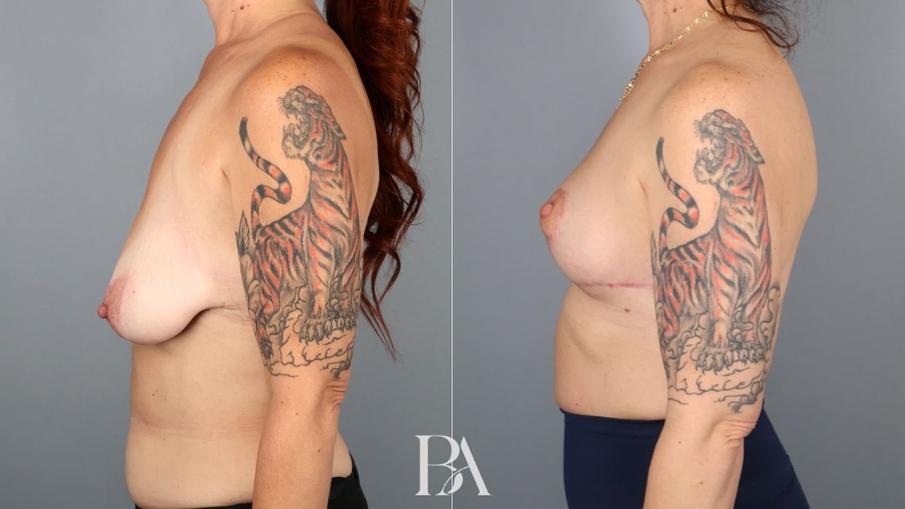 Breast lift before and after — side view, Dr. Beina Azadgoli, Beverly Hills