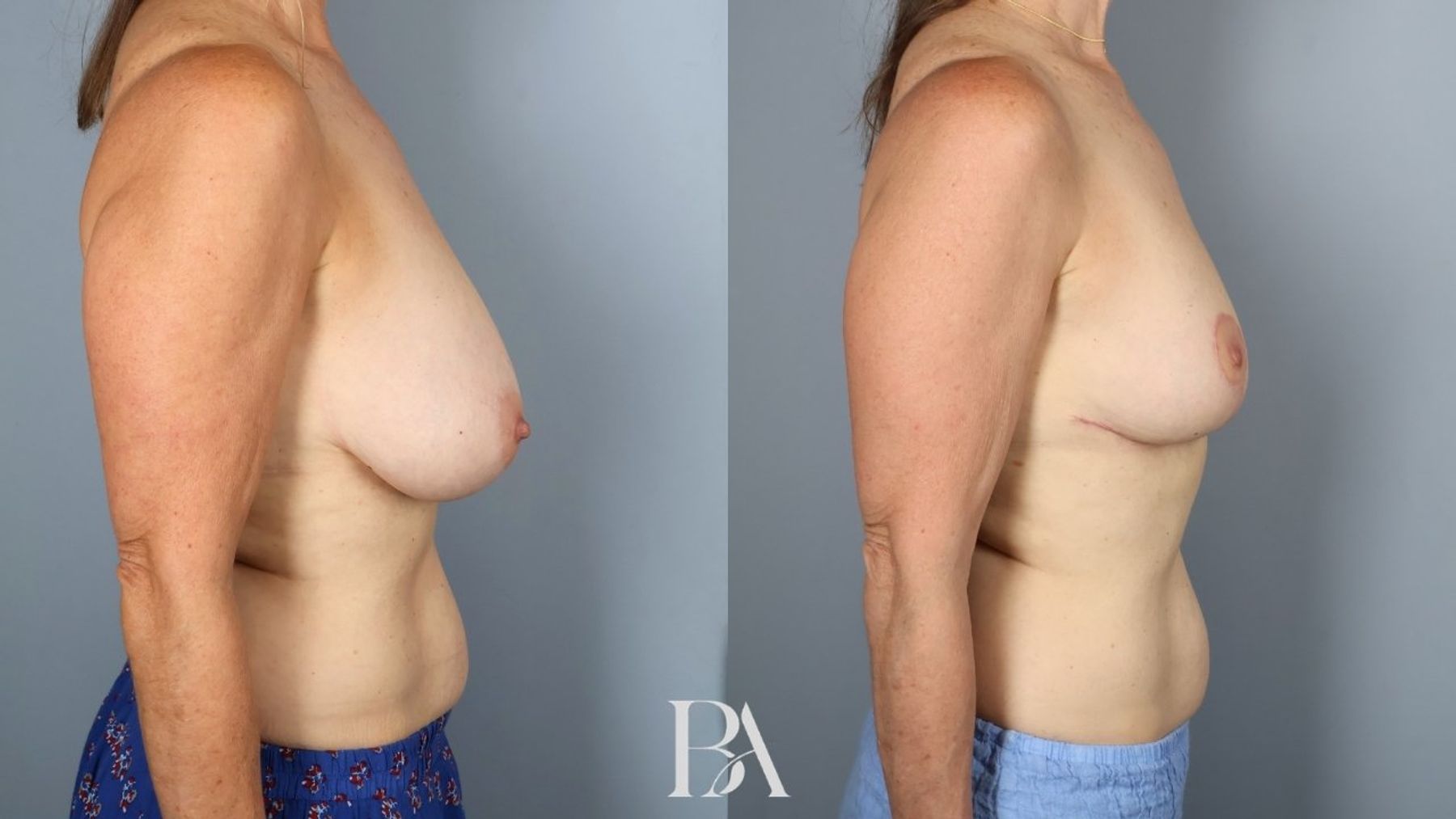 Breast reduction before and after — side view, Dr. Beina Azadgoli, Beverly Hills