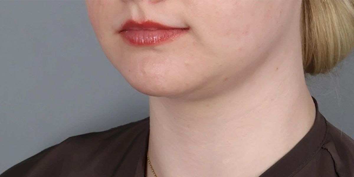 Case 4001 — Detail after